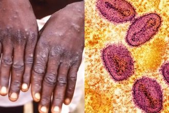 Health Ministry Confirms Malaysian Man Tests Positive for Mpox What You Need to Know