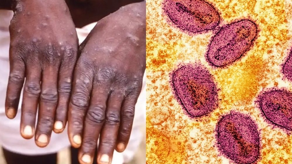 Health Ministry Confirms Malaysian Man Tests Positive for Mpox What You Need to Know